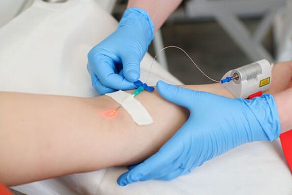 bacaklarda sedef hastalığı için intravenöz lazer tedavisi