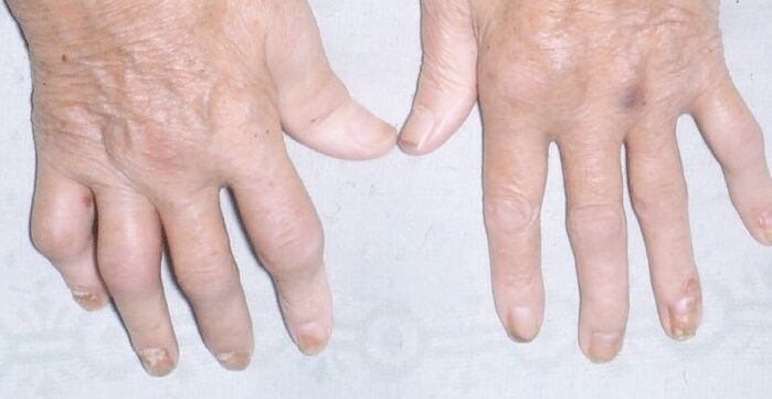ellerde artropatik sedef hastalığı