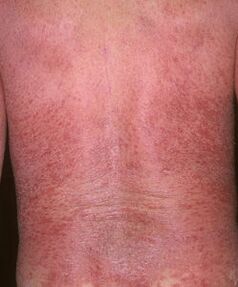 Eritroderma