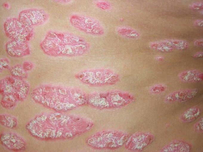 plak psoriazis