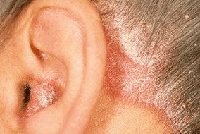 sedef hastalığının nedenleri